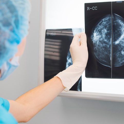 Breast Surgery