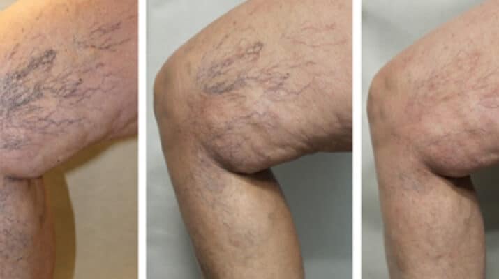 Varicose veins and spider veins